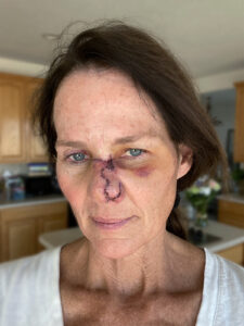 A photo ofKathy Sabine's Campaign Against Skin Cancer - WikiiTrends